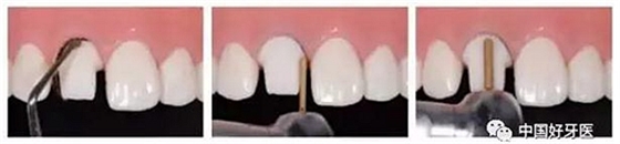 前牙全瓷冠牙體預(yù)備步驟 前牙全瓷冠牙體預(yù)備步驟