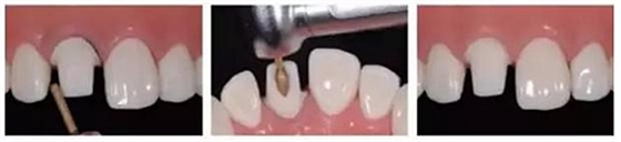 前牙全瓷冠牙體預(yù)備步驟 前牙全瓷冠牙體預(yù)備步驟