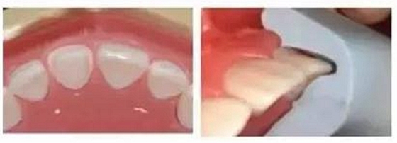 前牙全瓷冠牙體預(yù)備步驟 前牙全瓷冠牙體預(yù)備步驟