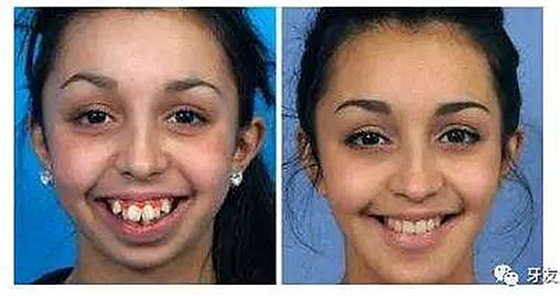 “發(fā)現(xiàn)即矯正”12歲前必須處理的20種兒童牙頜畸形 “發(fā)現(xiàn)即矯正”12歲前必須處理的20種兒童牙頜畸形