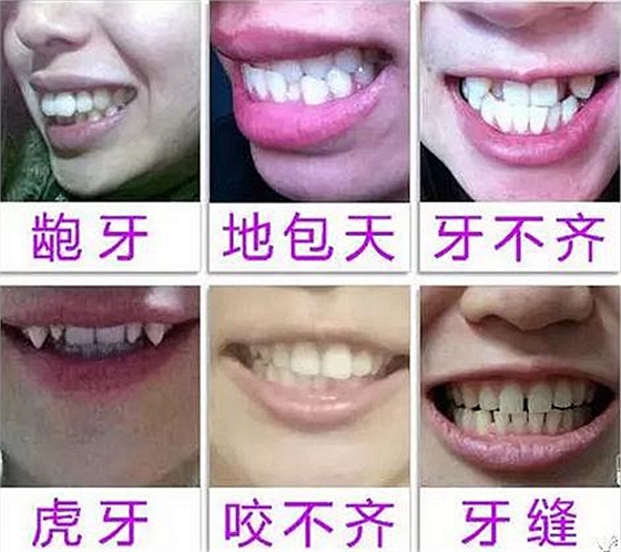 “發(fā)現(xiàn)即矯正”12歲前必須處理的20種兒童牙頜畸形 “發(fā)現(xiàn)即矯正”12歲前必須處理的20種兒童牙頜畸形