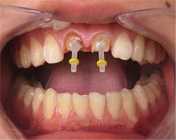美國CBD纖維樁簡介及纖維樁臨床操作步驟及樁核的若干問題 美國CBD纖維樁簡介及纖維樁臨床操作步驟及樁核的若干問題