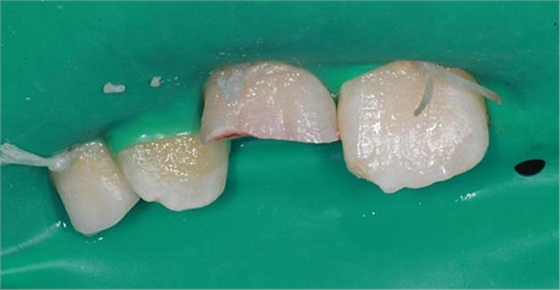劉勇:斷牙再粘結(jié)兩例病例 劉勇:斷牙再粘結(jié)兩例病例
