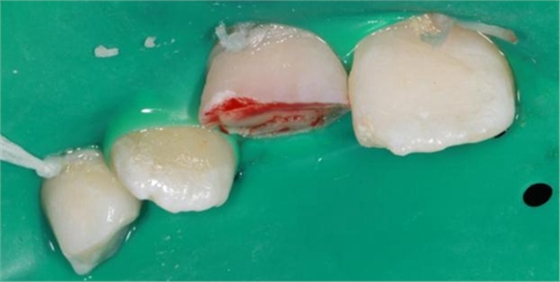 劉勇:斷牙再粘結(jié)兩例病例 劉勇:斷牙再粘結(jié)兩例病例