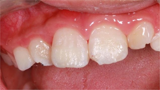 劉勇:斷牙再粘結(jié)兩例病例 劉勇:斷牙再粘結(jié)兩例病例