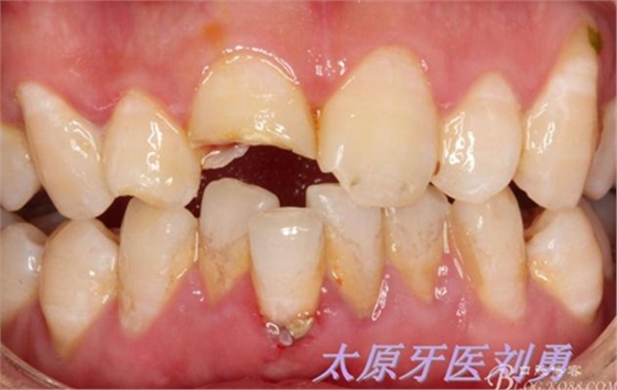 劉勇:斷牙再粘結(jié)兩例病例 劉勇:斷牙再粘結(jié)兩例病例
