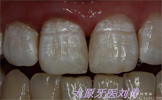 劉勇:斷牙再粘結(jié)兩例病例 劉勇:斷牙再粘結(jié)兩例病例