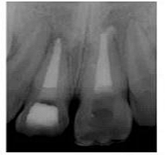 牙體大面積缺損:根管治療后行纖維樁—樹(shù)脂修復(fù) 牙體大面積缺損:根管治療后行纖維樁—樹(shù)脂修復(fù)