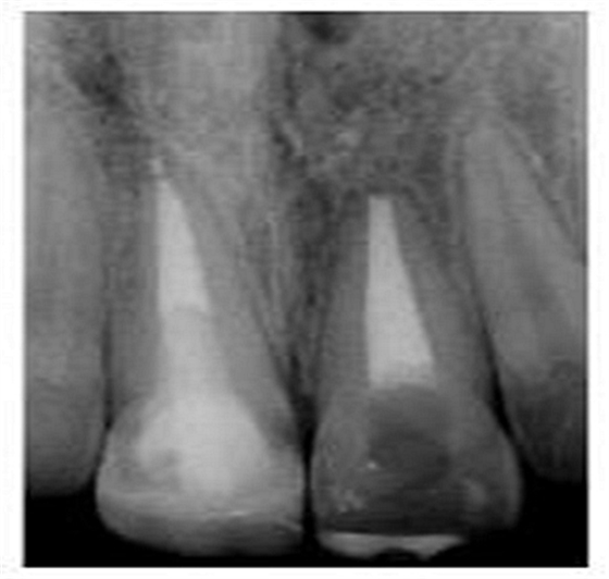 牙體大面積缺損:根管治療后行纖維樁—樹(shù)脂修復(fù) 牙體大面積缺損:根管治療后行纖維樁—樹(shù)脂修復(fù)
