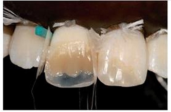 牙體大面積缺損:根管治療后行纖維樁—樹(shù)脂修復(fù) 牙體大面積缺損:根管治療后行纖維樁—樹(shù)脂修復(fù)