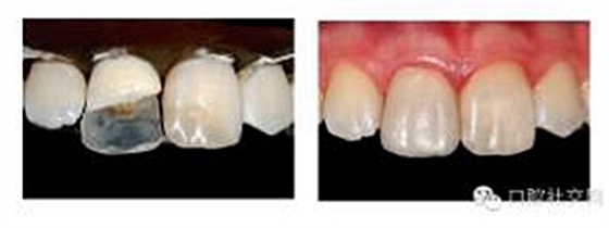 牙體大面積缺損:根管治療后行纖維樁—樹(shù)脂修復(fù) 牙體大面積缺損:根管治療后行纖維樁—樹(shù)脂修復(fù)