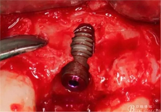 一例上前牙種植失敗病例的補(bǔ)救 一例上前牙種植失敗病例的補(bǔ)救