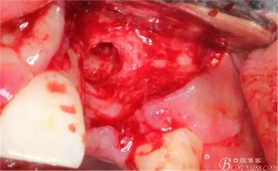 一例上前牙種植失敗病例的補(bǔ)救 一例上前牙種植失敗病例的補(bǔ)救