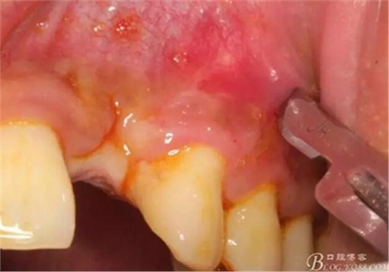 一例上前牙種植失敗病例的補(bǔ)救 一例上前牙種植失敗病例的補(bǔ)救