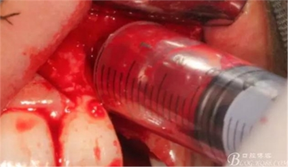 一例上前牙種植失敗病例的補(bǔ)救 一例上前牙種植失敗病例的補(bǔ)救