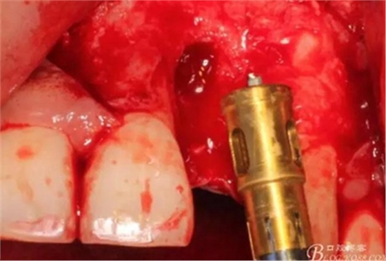 一例上前牙種植失敗病例的補(bǔ)救 一例上前牙種植失敗病例的補(bǔ)救