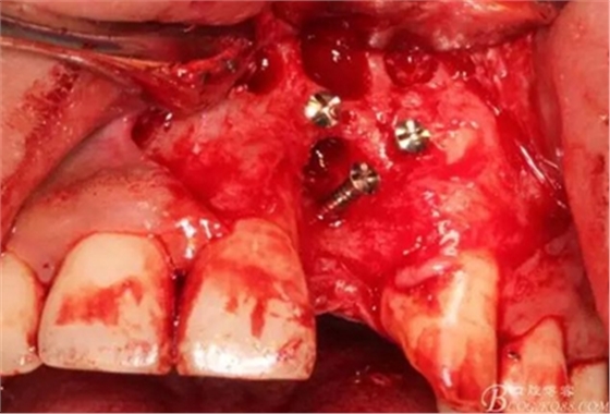 一例上前牙種植失敗病例的補(bǔ)救 一例上前牙種植失敗病例的補(bǔ)救