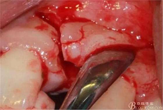 一例上前牙種植失敗病例的補(bǔ)救 一例上前牙種植失敗病例的補(bǔ)救