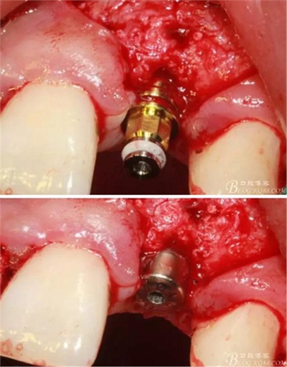 一例上前牙種植失敗病例的補(bǔ)救 一例上前牙種植失敗病例的補(bǔ)救