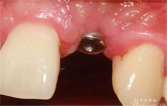 一例上前牙種植失敗病例的補(bǔ)救 一例上前牙種植失敗病例的補(bǔ)救