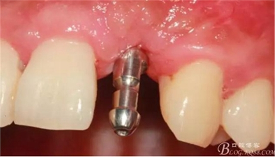 一例上前牙種植失敗病例的補(bǔ)救 一例上前牙種植失敗病例的補(bǔ)救