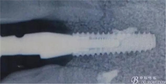 一例上前牙種植失敗病例的補(bǔ)救 一例上前牙種植失敗病例的補(bǔ)救