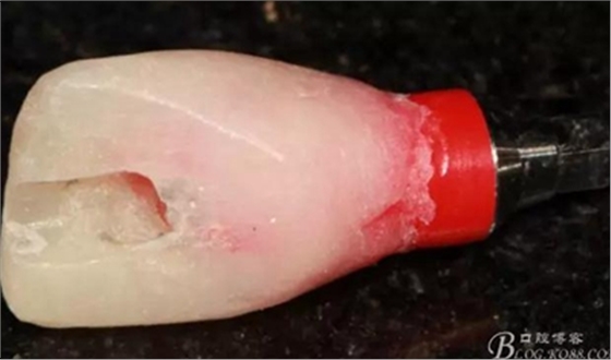 一例上前牙種植失敗病例的補(bǔ)救 一例上前牙種植失敗病例的補(bǔ)救