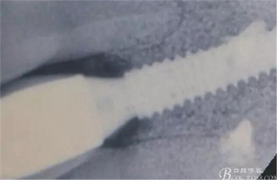 一例上前牙種植失敗病例的補(bǔ)救 一例上前牙種植失敗病例的補(bǔ)救