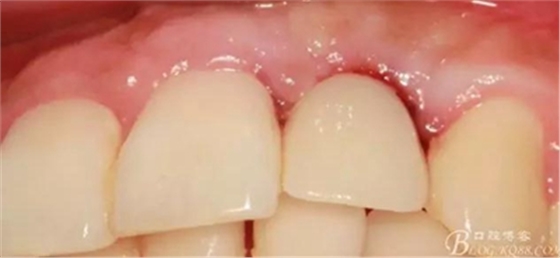 一例上前牙種植失敗病例的補(bǔ)救 一例上前牙種植失敗病例的補(bǔ)救