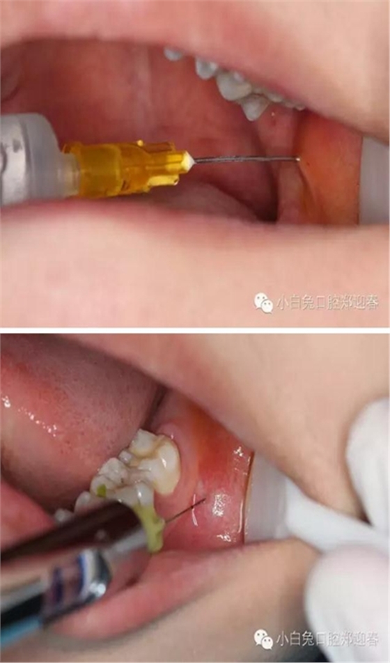 (原創(chuàng))//圖解微創(chuàng)舒適拔牙全過(guò)程 (原創(chuàng))//圖解微創(chuàng)舒適拔牙全過(guò)程