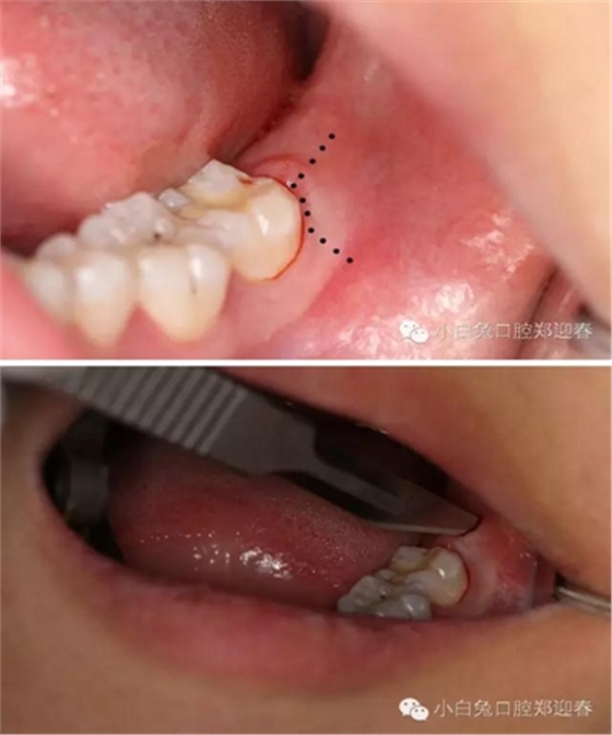 (原創(chuàng))//圖解微創(chuàng)舒適拔牙全過(guò)程 (原創(chuàng))//圖解微創(chuàng)舒適拔牙全過(guò)程