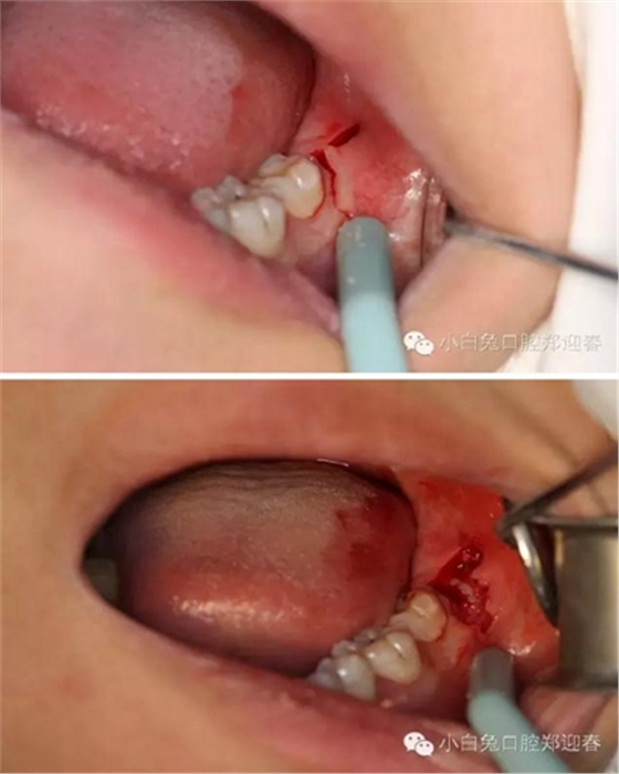 (原創(chuàng))//圖解微創(chuàng)舒適拔牙全過(guò)程 (原創(chuàng))//圖解微創(chuàng)舒適拔牙全過(guò)程