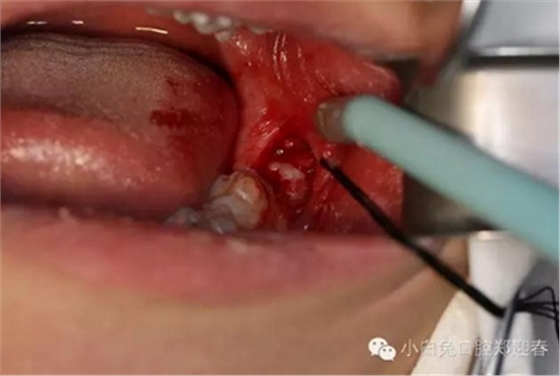 (原創(chuàng))//圖解微創(chuàng)舒適拔牙全過(guò)程 (原創(chuàng))//圖解微創(chuàng)舒適拔牙全過(guò)程