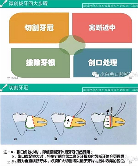 (原創(chuàng))//圖解微創(chuàng)舒適拔牙全過(guò)程 (原創(chuàng))//圖解微創(chuàng)舒適拔牙全過(guò)程