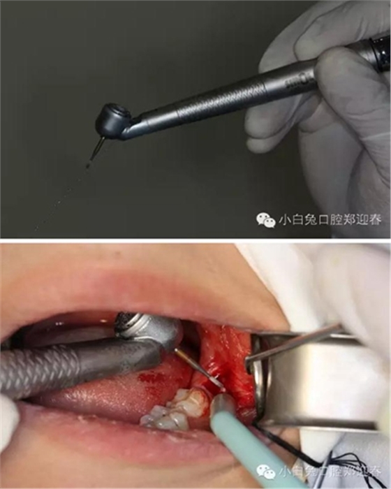(原創(chuàng))//圖解微創(chuàng)舒適拔牙全過(guò)程 (原創(chuàng))//圖解微創(chuàng)舒適拔牙全過(guò)程
