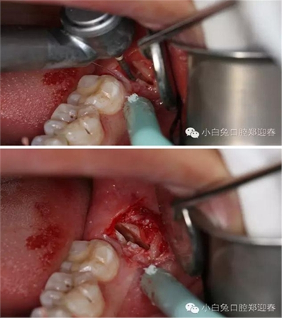 (原創(chuàng))//圖解微創(chuàng)舒適拔牙全過(guò)程 (原創(chuàng))//圖解微創(chuàng)舒適拔牙全過(guò)程