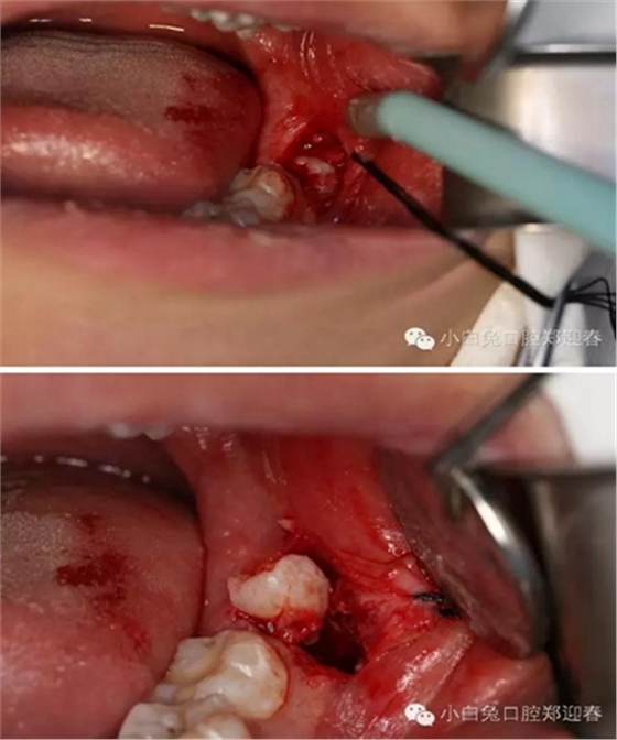 (原創(chuàng))//圖解微創(chuàng)舒適拔牙全過(guò)程 (原創(chuàng))//圖解微創(chuàng)舒適拔牙全過(guò)程