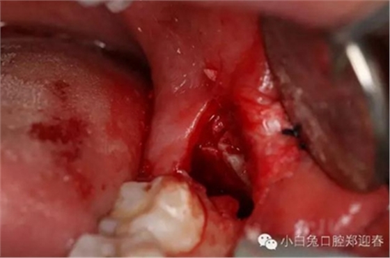 (原創(chuàng))//圖解微創(chuàng)舒適拔牙全過(guò)程 (原創(chuàng))//圖解微創(chuàng)舒適拔牙全過(guò)程