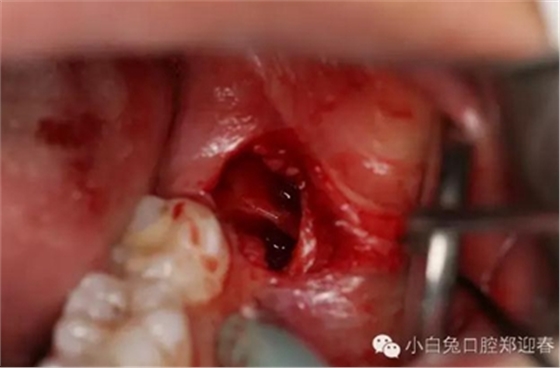 (原創(chuàng))//圖解微創(chuàng)舒適拔牙全過(guò)程 (原創(chuàng))//圖解微創(chuàng)舒適拔牙全過(guò)程