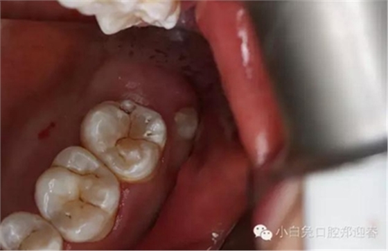 (原創(chuàng))//圖解微創(chuàng)舒適拔牙全過(guò)程 (原創(chuàng))//圖解微創(chuàng)舒適拔牙全過(guò)程