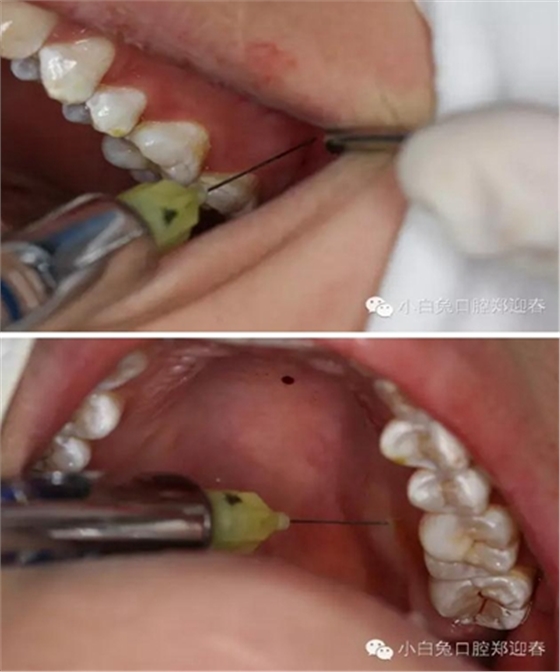 (原創(chuàng))//圖解微創(chuàng)舒適拔牙全過(guò)程 (原創(chuàng))//圖解微創(chuàng)舒適拔牙全過(guò)程