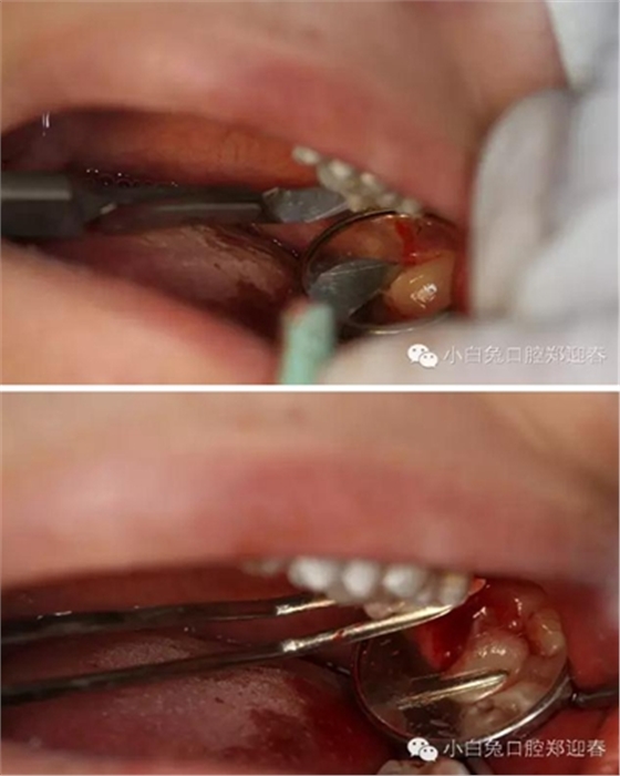 (原創(chuàng))//圖解微創(chuàng)舒適拔牙全過(guò)程 (原創(chuàng))//圖解微創(chuàng)舒適拔牙全過(guò)程