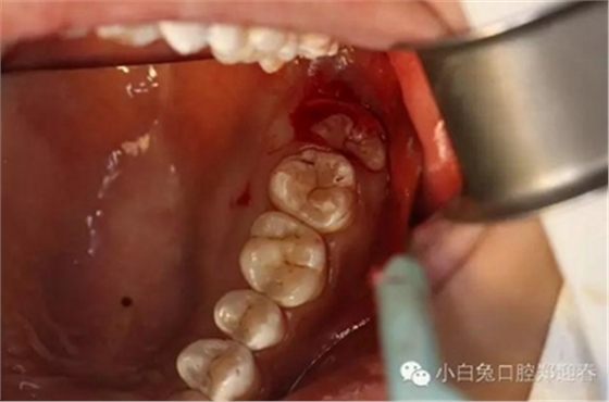 (原創(chuàng))//圖解微創(chuàng)舒適拔牙全過(guò)程 (原創(chuàng))//圖解微創(chuàng)舒適拔牙全過(guò)程