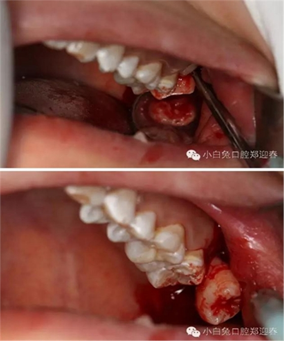 (原創(chuàng))//圖解微創(chuàng)舒適拔牙全過(guò)程 (原創(chuàng))//圖解微創(chuàng)舒適拔牙全過(guò)程