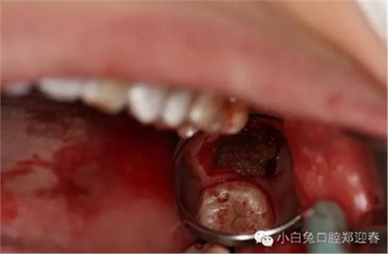 (原創(chuàng))//圖解微創(chuàng)舒適拔牙全過(guò)程 (原創(chuàng))//圖解微創(chuàng)舒適拔牙全過(guò)程