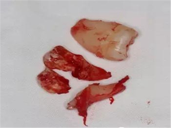 (原創(chuàng))//圖解微創(chuàng)舒適拔牙全過(guò)程 (原創(chuàng))//圖解微創(chuàng)舒適拔牙全過(guò)程