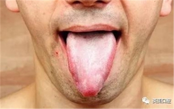 艾滋病早期重要癥狀:口腔的各種表現(xiàn) 艾滋病早期重要癥狀:口腔的各種表現(xiàn)