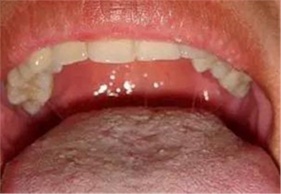 艾滋病早期重要癥狀:口腔的各種表現(xiàn) 艾滋病早期重要癥狀:口腔的各種表現(xiàn)