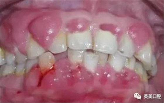 艾滋病早期重要癥狀:口腔的各種表現(xiàn) 艾滋病早期重要癥狀:口腔的各種表現(xiàn)