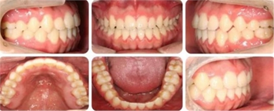 種植釘多維運用矯正高角反頜及開頜—對羅晨醫(yī)生專訪及病例展示(上) 種植釘多維運用矯正高角反頜及開頜—對羅晨醫(yī)生專訪及病例展示(上)
